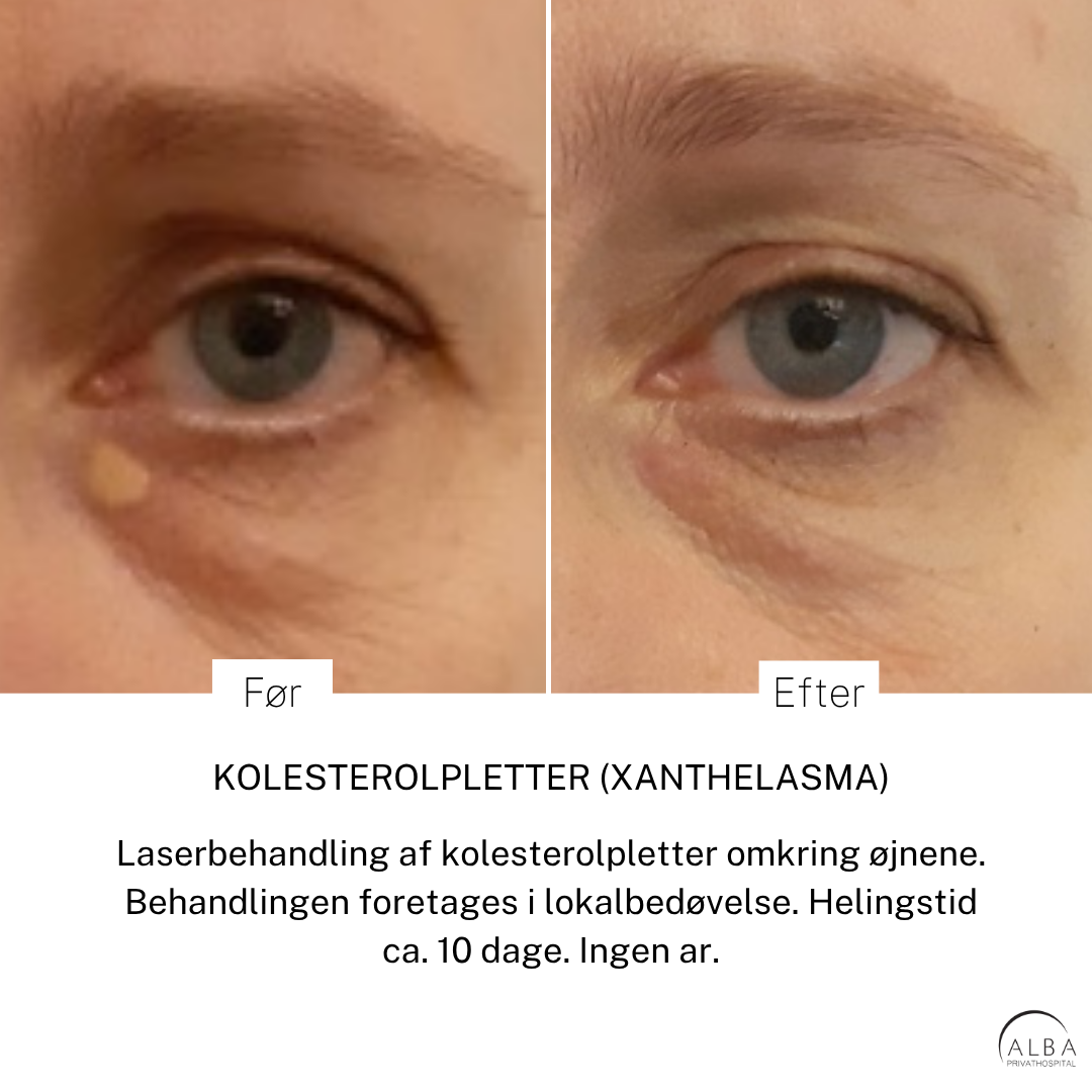 Kolesterolpletter før & efter laserbehandling - ALBA Privathospital