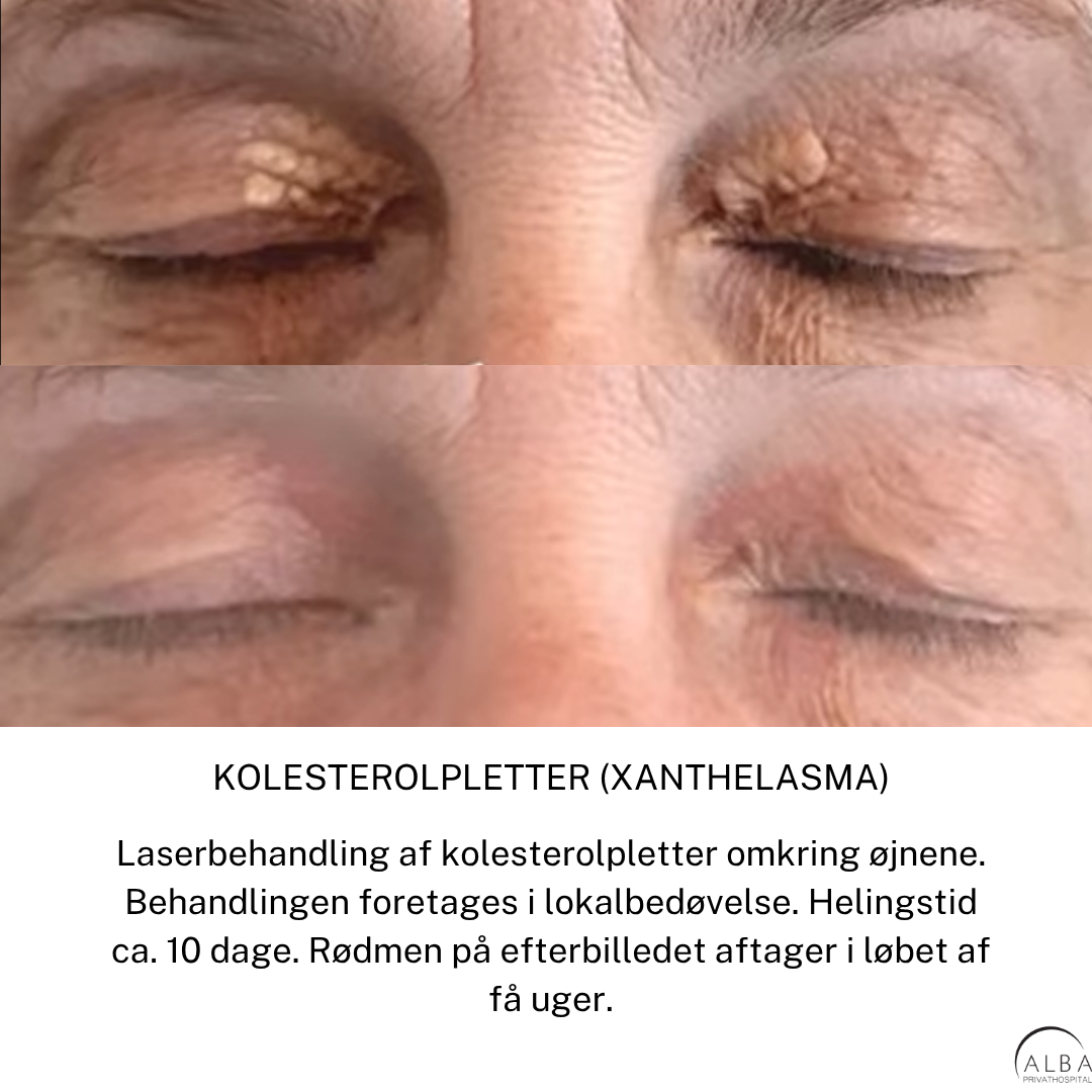 Xanthelasma før & efter laserbehandling - ALBA Privathospital