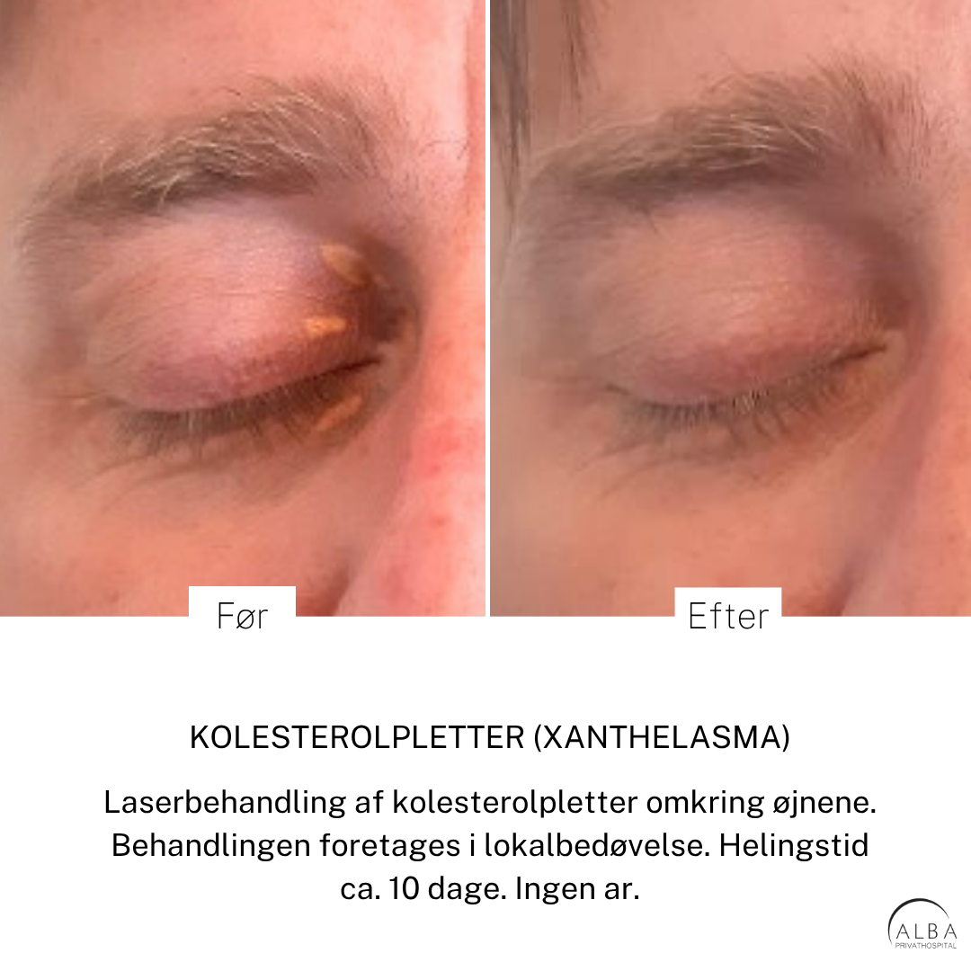 Kolesterolpletter - xanthelasma - før & efter laserbehandling - ALBA Privathospital