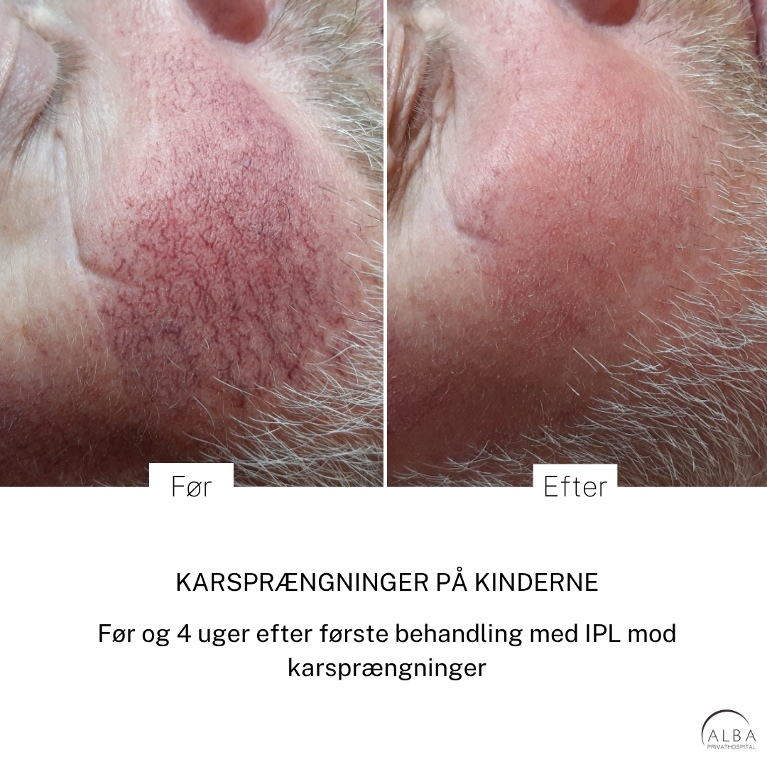 IPL behandling af karsprængninger Karsprængninger - før efter - ALBA Privathospital
