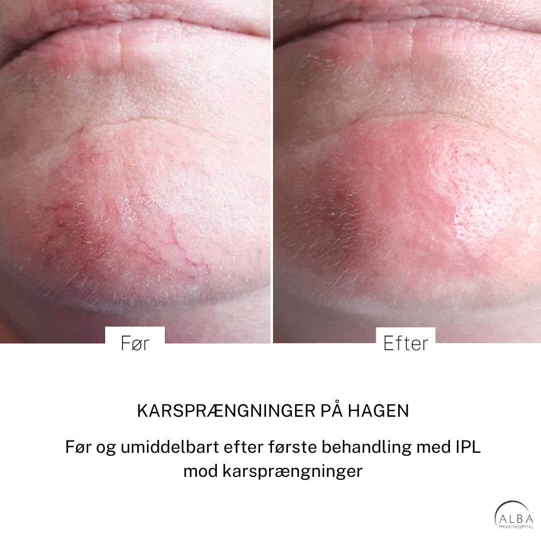 IPL behandling af karsprængninger Karsprængninger - før efter - ALBA Privathospital